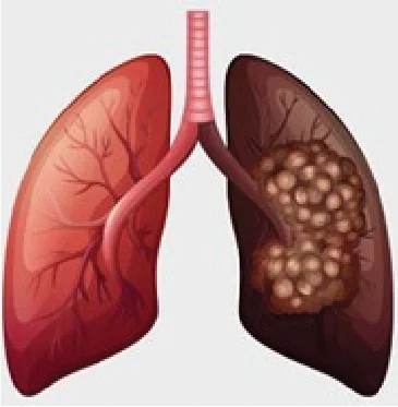 What is Lung Cancer and how can we prevent it